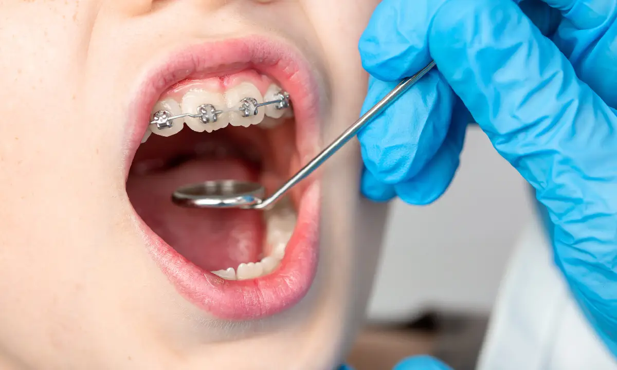 Dentofacial orthopedics for jaw alignment correction